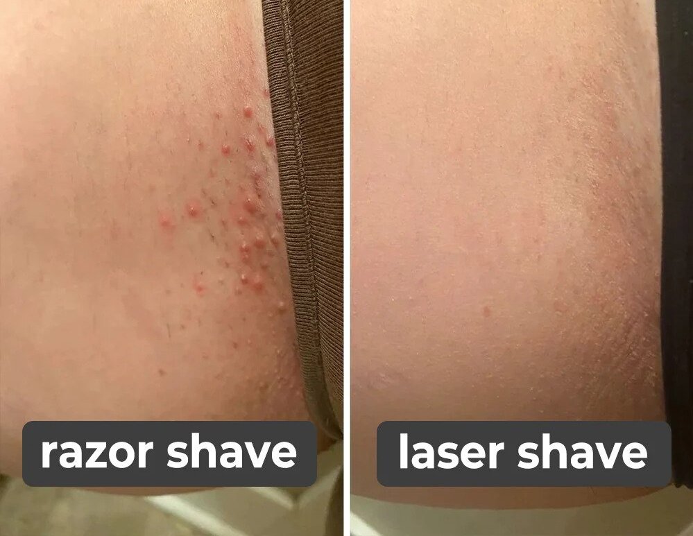 Electric Laser Hair Remover - Buy 1 Get 1 Free